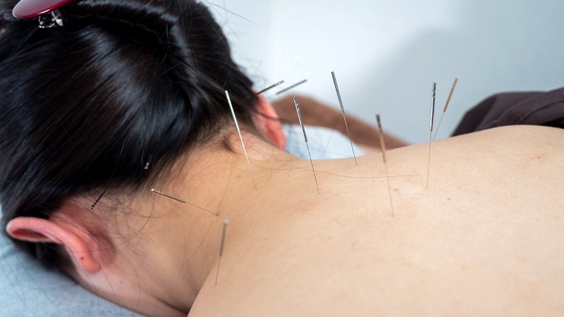 頭痛に対するトリガーポイント鍼治療の様子