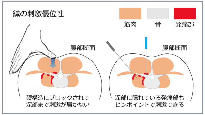 鍼の物理的優位性のイメージ